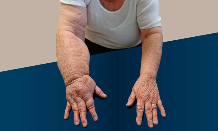Linfedema